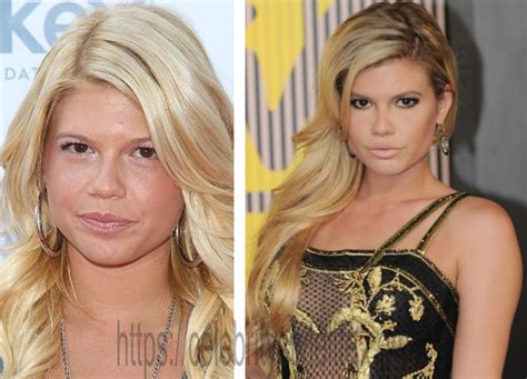 chanel west coast before surgery|chanel west coast liposuction.